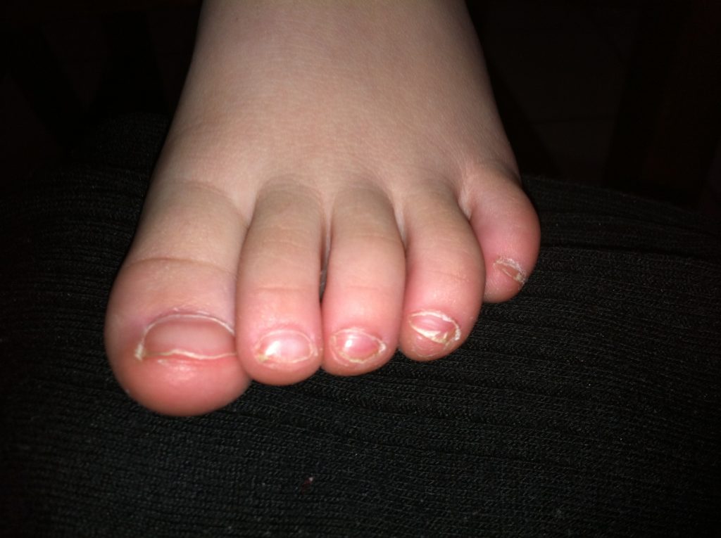 Childrens Podiatry | curly toes