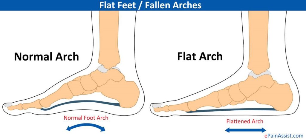 Childrens Podiatry | Flat Feet