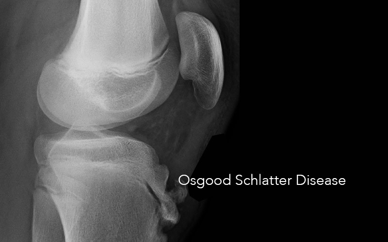 Childrens Podiatry | What is Osgood Schlatter Disease?